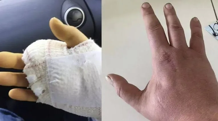 Pişik barmağını dişlədi, 15 dəfə əməliyyat olundu, lakin sonda - ÖLDÜ