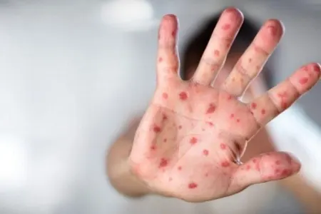 Hansı allergik reaksiyalar zamanı antibiotik təyin edilməlidir? - AÇIQLAMA
