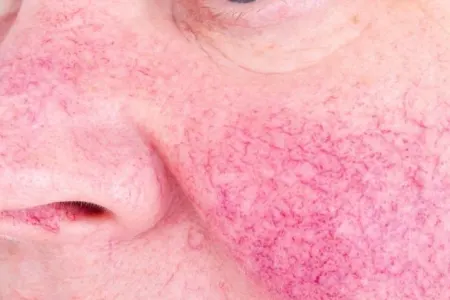 Azərbaycanda qadının üzünə E vitamini yeridilib - – Dəhşətli fəsad