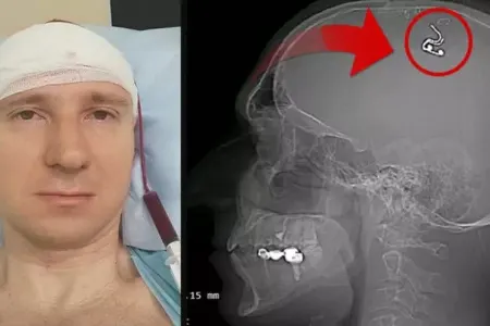 Çip yerləşdirmək üçün başını burğu ilə deşdi