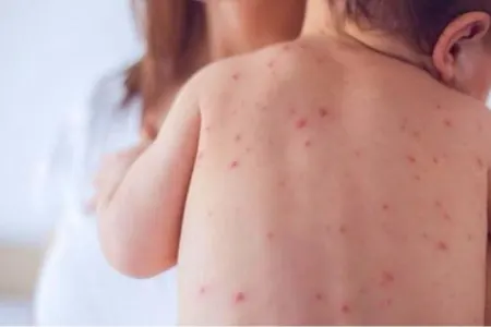 Uşaqlar arasında virus: - "Sayı Sürətlə Artır"