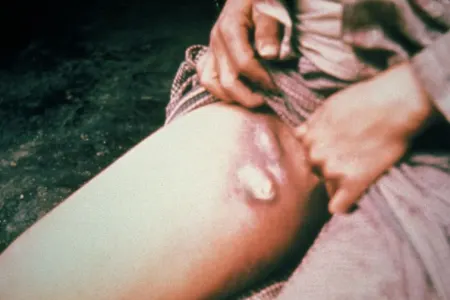 Yeni vəba epidemiyası artacaq - XƏBƏRDARLIQ