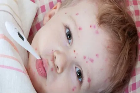 SON DƏQİQƏ!! Azərbaycanda daha bir uşaq qızılcadan öldü