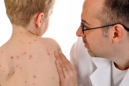 Qaxda qızılcaya ilk yoluxma qeydə alınıb