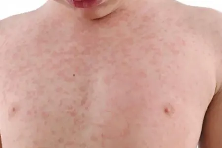 Qızılca ilə bağlı YENİ XƏBƏR: Bu rayonda da...