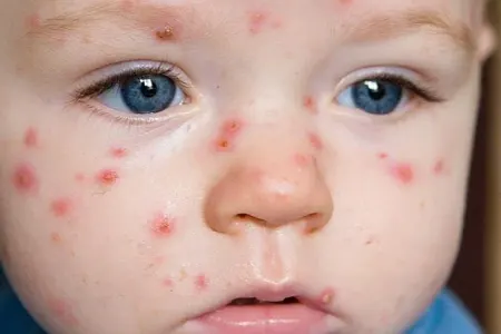 Bu ölkədə qızılca epidemiyası elan edildi