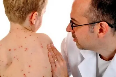 Naxçıvanda qızılca ilə bağlı SON VƏZİYYƏT - AÇIQLANDI