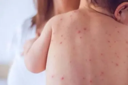 Səhiyyə Nazirliyindən qızılca ilə bağlı valideynlərə - ÇAĞIRIŞ