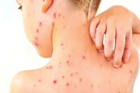 Azərbaycanda 4 yaşlı uşaq qızılcadan öldü