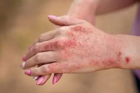 Qızılca peyvəndi ilə bağlı əhaliyə - ÇAĞIRIŞ