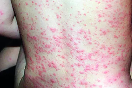 Qızılcaya yoluxan uşaqla bağlı TƏBİB-dən açıqlama