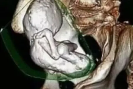 Tibb aləmində ŞOK: - qarnında 35 illik körpə var imiş