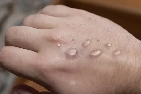 Rusiyada meymunçiçəyi virusuna iki yoluxma qeydə alınıb