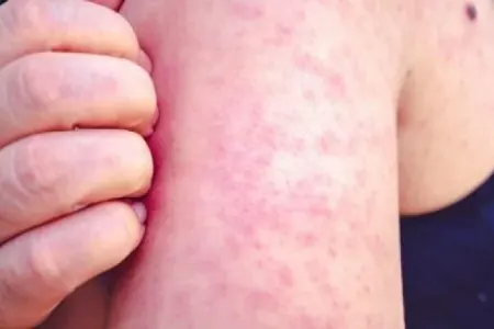 Qızılcaya yoluxanlar buna görə ölür - Həkimdən SOS