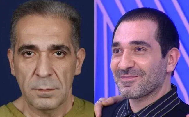 Nurlan Əzizbəyli plastik əməliyyatla üzünü "dəyişdirdi" - FOTO