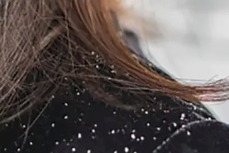 Saçda yaranan kəpək və onunla mübarizə - ÜSULLARI