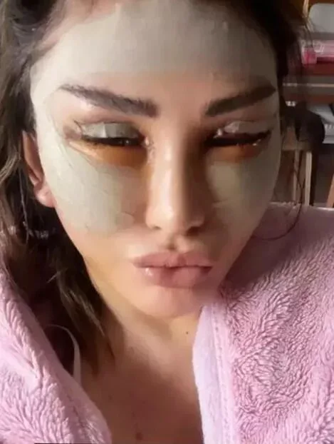 Məşhur müğənni plastik əməliyyatdan sonra - FOTO