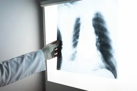 Həkim son zamanlar geniş yayılan vərəm xəstəliyindən danışdı