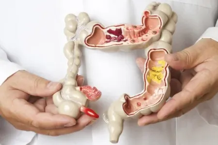 Bağırsaq xərçənginin qarşısını almağın 5 üsulu