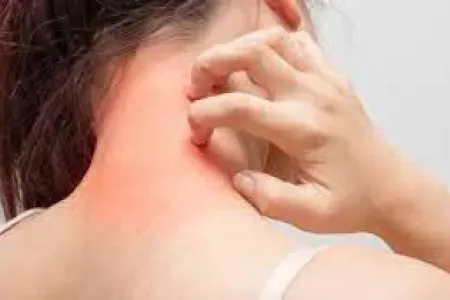 Allergiya nədir və onu necə müalicə etmək olar?