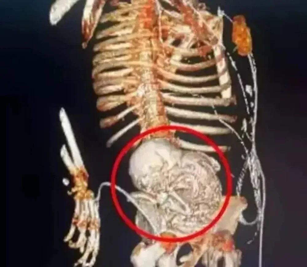 Tibb aləmində tükürpədən nadir hadisə - FOTO