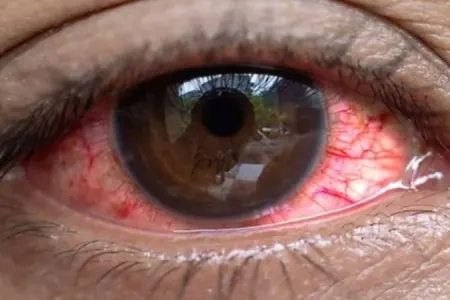 Yeni epidemiya: - "Qırmızı göz" xəstəliyi