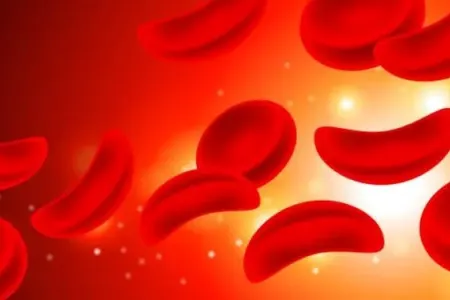 Yeni araşdırma: - Bu qan qrupunun insult riski daha yüksəkdir