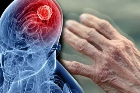 Parkinson xəstəliyinin genetik səbəbi tapıldı