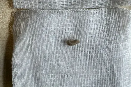 Xəstəxanaya getdi: - qulağından qurdlar çıxarıldı