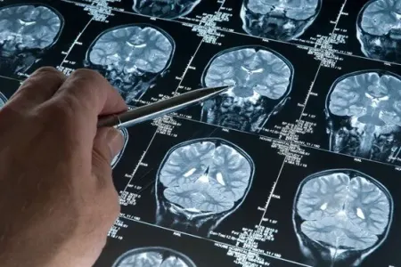 Bu Alzheimer riskini artıra bilər