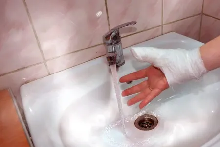 Yanıq xəsarəti aldıqda bunları - ƏSLA ETMƏYİN!