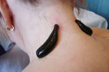 Zəlinin insan orqanizmi üçün inanılmaz - FAYDALARI