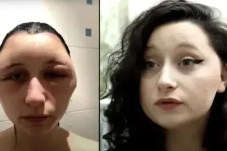 Dəhşətli hadisə: Gənc qız saçını boyadı, - üzü "lampa"ya DÖNDÜ - FOTOLAR