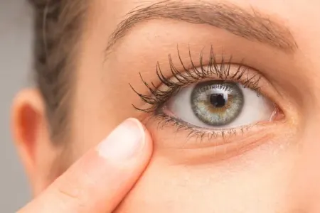 Bir həftəyə gözaltı qaralardan xilas olacaqsınız - Sadə üsul