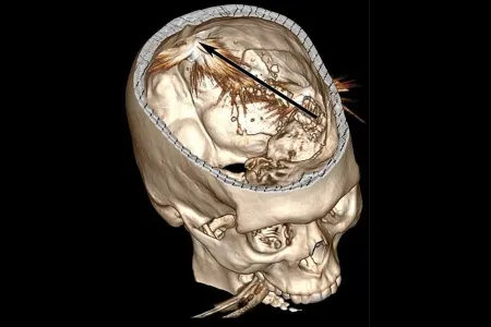 Başına güllə atılan şəxs ölmədi