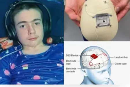 Yeniyetmənin beyninə implant yerləşdirildi