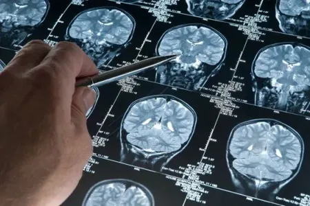 Alzheimer xəstələrinə nə kömək edə bilər?