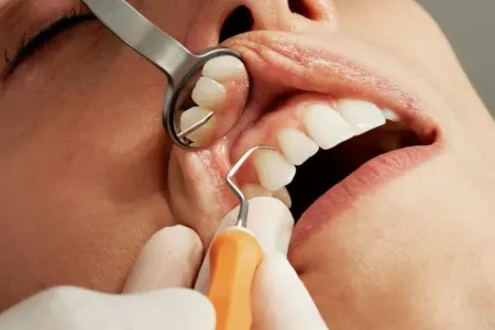 Diş çıxaran dərman satışa çıxarılır - – Tarix açıqlandı