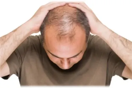 Saç tökülməsi B2 vitamini çatışmazlığının əlamətidir