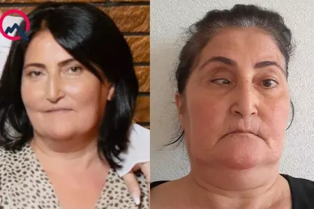 Burun əməliyyatına girən qadının gözündə çəplik yarandı - Foto