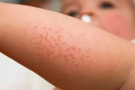 İsti havada səpgilərə diqqət yetirin!