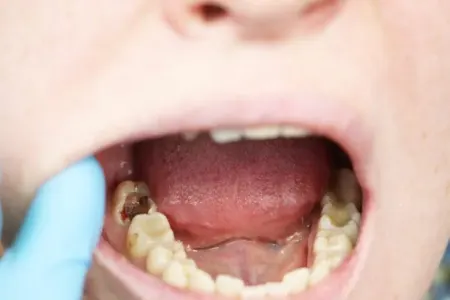 Diş həkimi hər kəsə daha çox pendir yeməyi tövsiyə edir - SƏBƏBİ