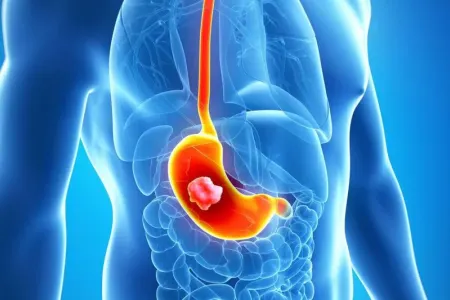 Həkimlərin “qara siyahı”sına düşən qidalar: - xərçəngə səbəb olurlar