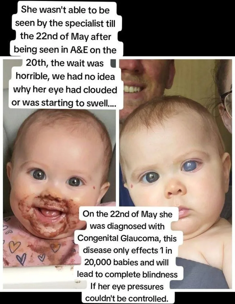 Dünyada nadir xəstəlik: - 21 aylıq körpə qan ağlayır! – FOTOLAR