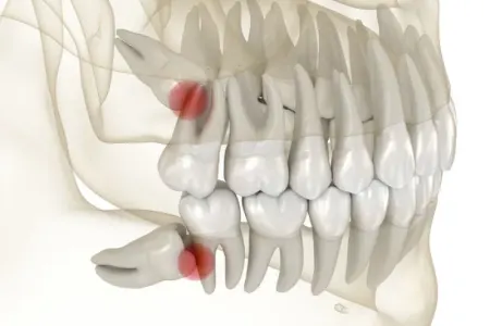 Ağıl dişləri nə üçündür? - – Heç düşünmüsünüzmü?