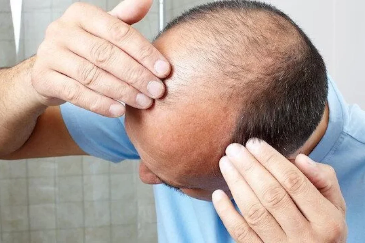 Keçəllikdən xilas edən - YENİ ÜSUL