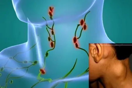 Qan xərçəngində bədəndə hara ağrıyır?