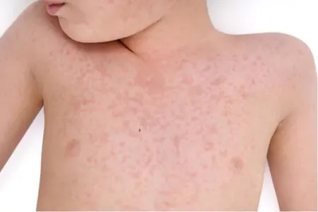 "İsti hava uşaqlarda allergik reaksiyalar yarada bilər" - AÇIQLAMA