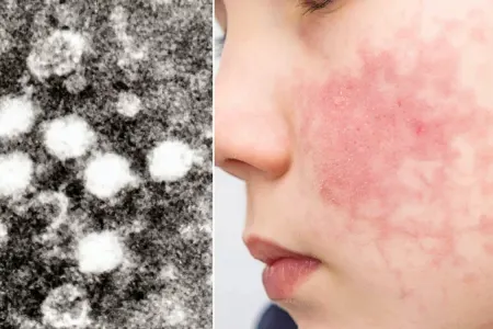 Parvovirus yoluxmalarında - böyük artım