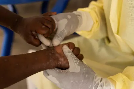 Nigeriyada 39 Meymunçiçəyi - aşkar edildi